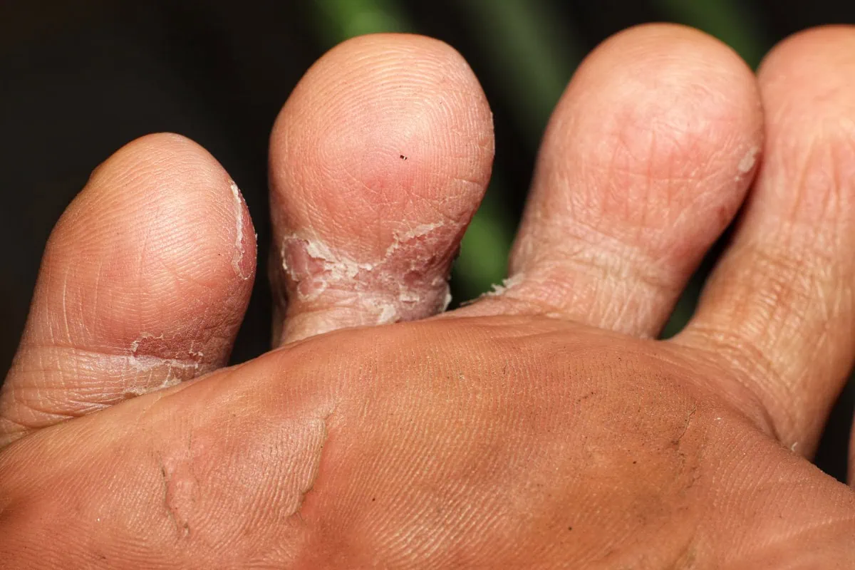 <p>A fungal skin infection affecting the feet, often called athlete's foot, characterized by itching, redness, and peeling skin. </p>