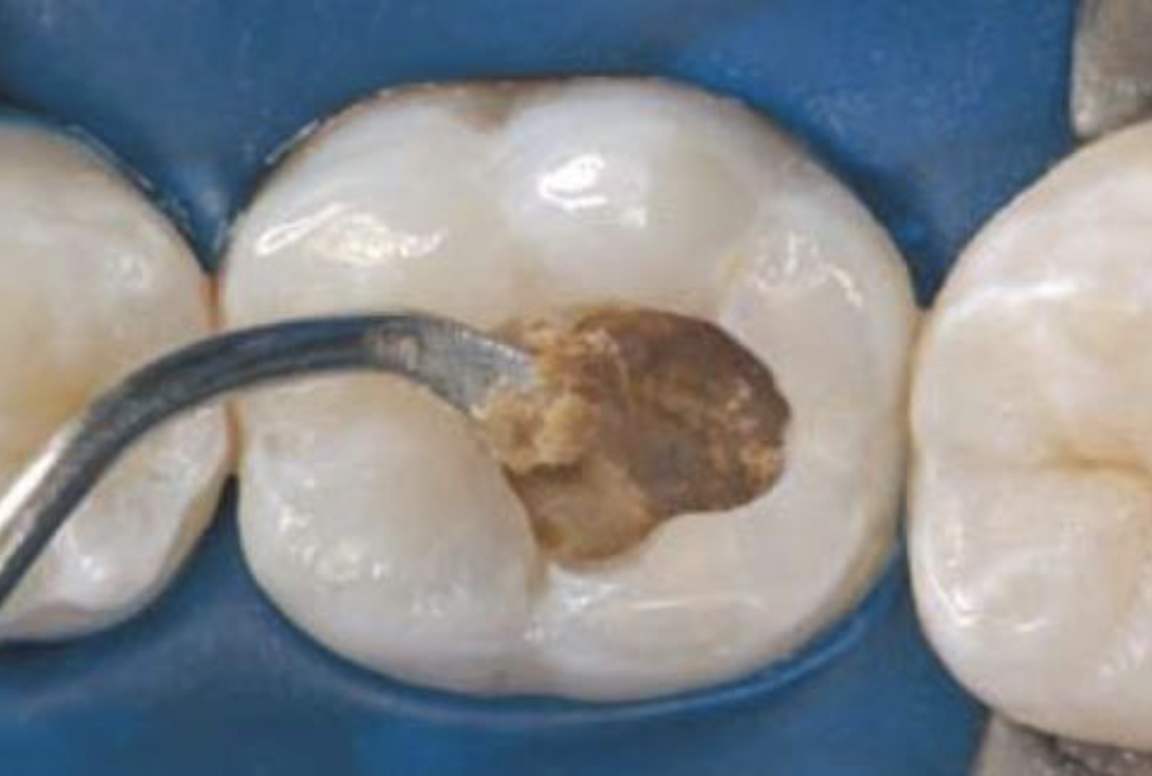<p>Soft Dentin</p>