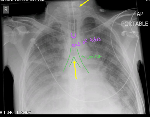 <ul><li><p>Keeps airway open if obstruction or respiratory failure.</p></li><li><p>End of tube 5-7 cm above carina</p></li></ul><p></p>