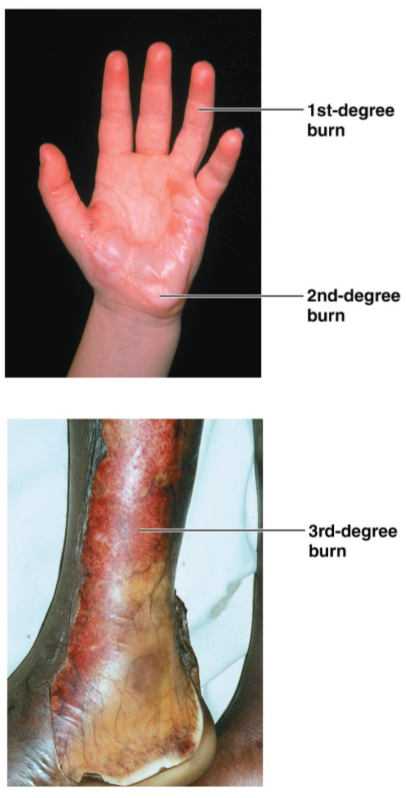 <ul><li><p><strong>1st</strong>: injured epidermis only</p></li><li><p><strong>2nd</strong>: injured epidermis &amp; 1st layer of dermis</p></li><li><p><strong>3rd</strong>: injury to full thickness of skin</p></li></ul><p></p>