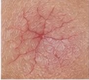 <p><span>Permanent dilation of preexisting small blood vessels (capillaries, arterioles, or venules) producing fine, irregular red line (e.g., rosacea, sun damage)</span></p>