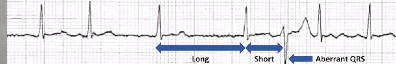 <p><strong>Aberrant ventricular conduction due to changes in QRS cycle length</strong></p><ul><li><p>Associated with AF: irregularly irregular conduction</p></li><li><p><strong>Long-short rule</strong>: the earlier in the cycle the PAC occurs and the longer the preceding cycle, the more likely the PAC will be conducted aberrantly</p></li></ul><p></p>