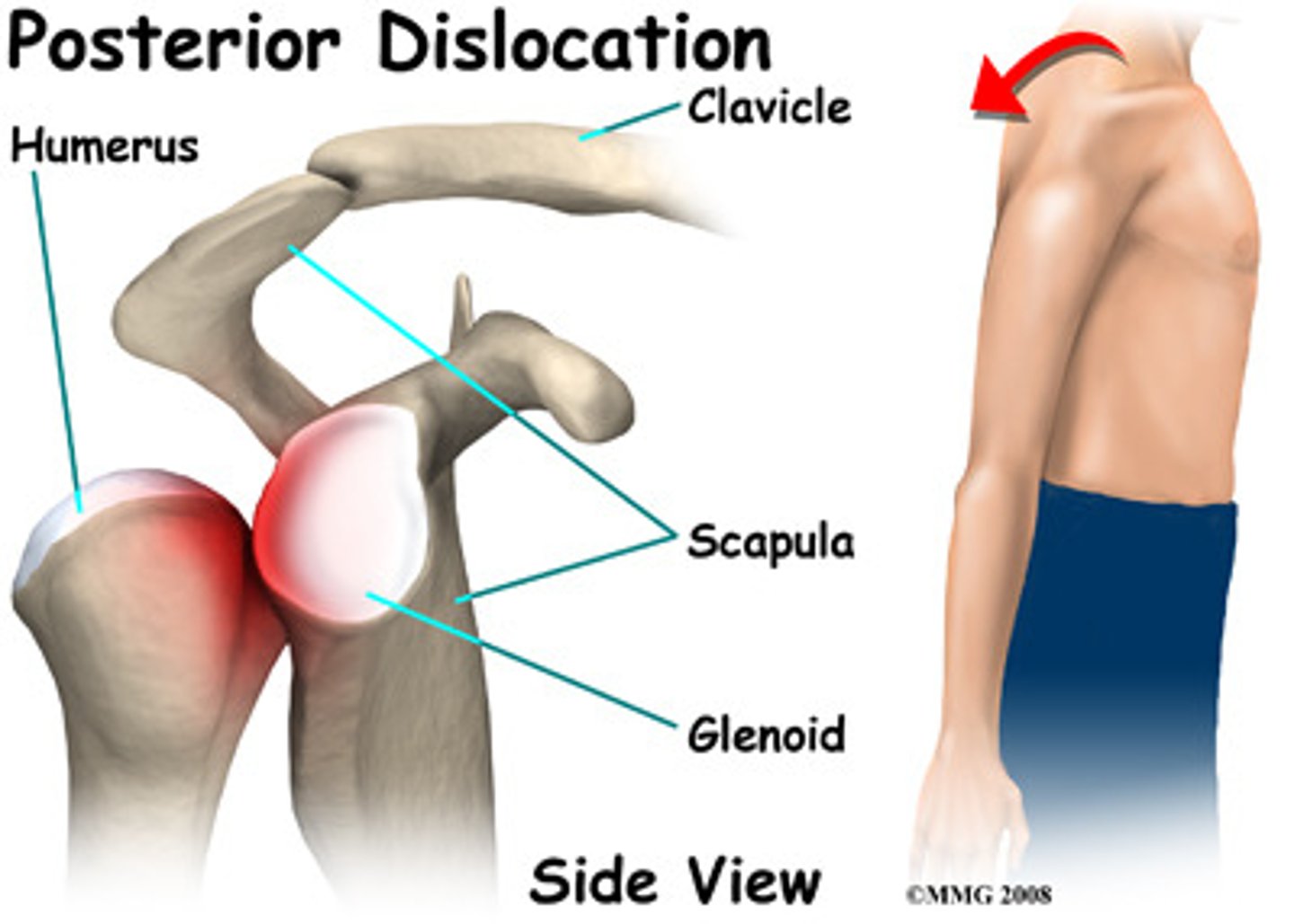 <p>combining excessive horizontal adduction and medial rotation</p>