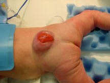 <p>most severe form of spina bifida in which the spinal cord and meninges protrude through the spine</p>