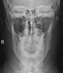 <p><span style="background-color: transparent;">Mandible - Towne</span></p>