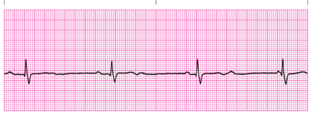 <p>QRS</p>