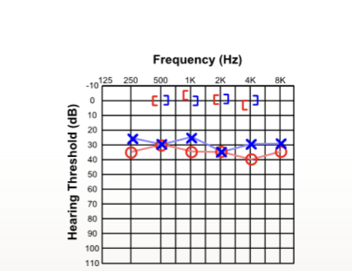 <p>what type of hearing loss</p>
