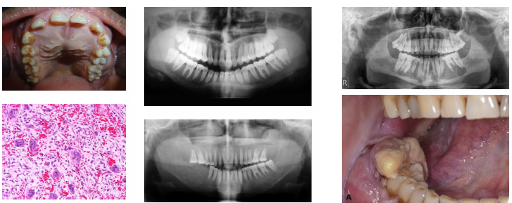 <p></p><p>•Diagnosis shows elevated PTH and calcium levels</p><p>•Primary treated with surgical gland removal</p><p>•Secondary managed by correcting hypocalcemia</p><p>•Vitamin D and diet used in renal patients</p><p>•Dental findings may prompt initial diagnosis</p>