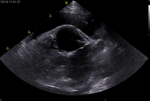 <p>What view is this echo and label?</p><p><em>What abnormalities is it showing?</em></p>