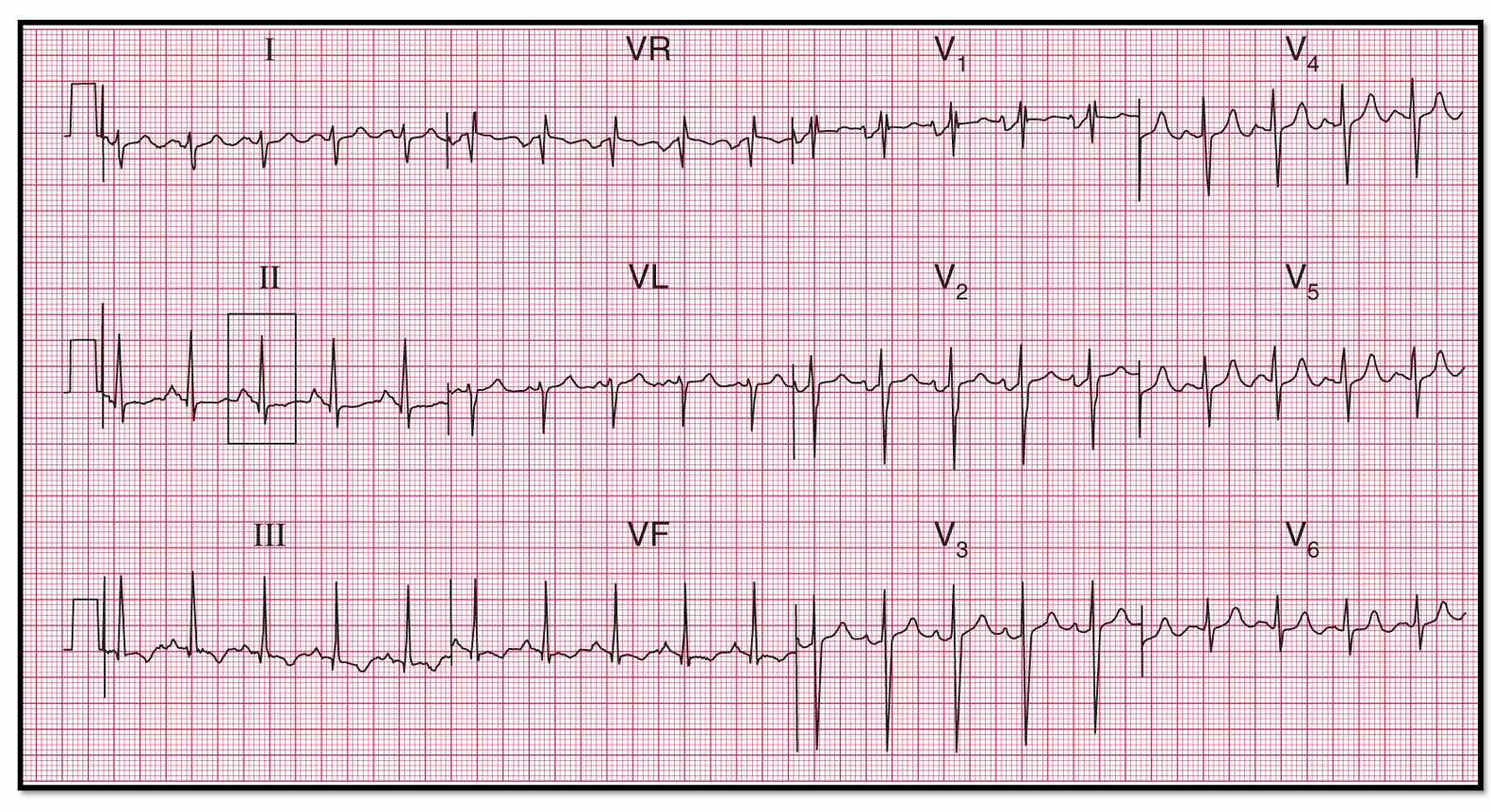 <p>Ritme, FC, eix electric, P, PR i QRS</p>