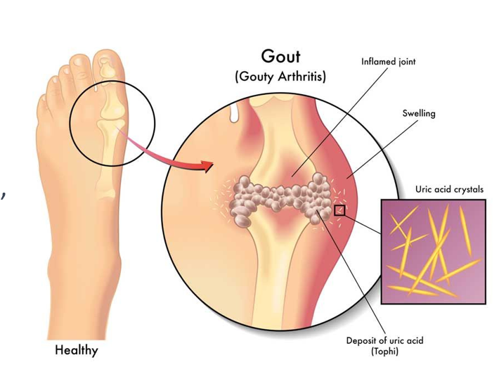 <p>A type of <strong>arthritis </strong>that is caused by the <strong>deposition of uric acid crystals</strong> in the joints</p><ul><li><p>Causes inflammation, pain, and immobility</p></li><li><p>Kidneys play a crucial role in regulating the level of uric acid in the blood</p></li><li><p>Risk Factors include</p><ul><li><p>Obesity</p></li><li><p>High BP</p></li><li><p>Diabetes</p></li><li><p>Diet high in purines</p></li><li><p>Diet rich in red meat and organ meat</p></li></ul></li><li><p>Treatment</p><ul><li><p>Medications</p></li><li><p>Lifestyle changes to reduce inflammation and prevent future attacks</p></li></ul></li><li><p>Left Untreated</p><ul><li><p>Joint damage</p></li><li><p>Kidney damage</p></li><li><p>Development of tophi (swollen joints)</p></li></ul></li></ul><p></p>