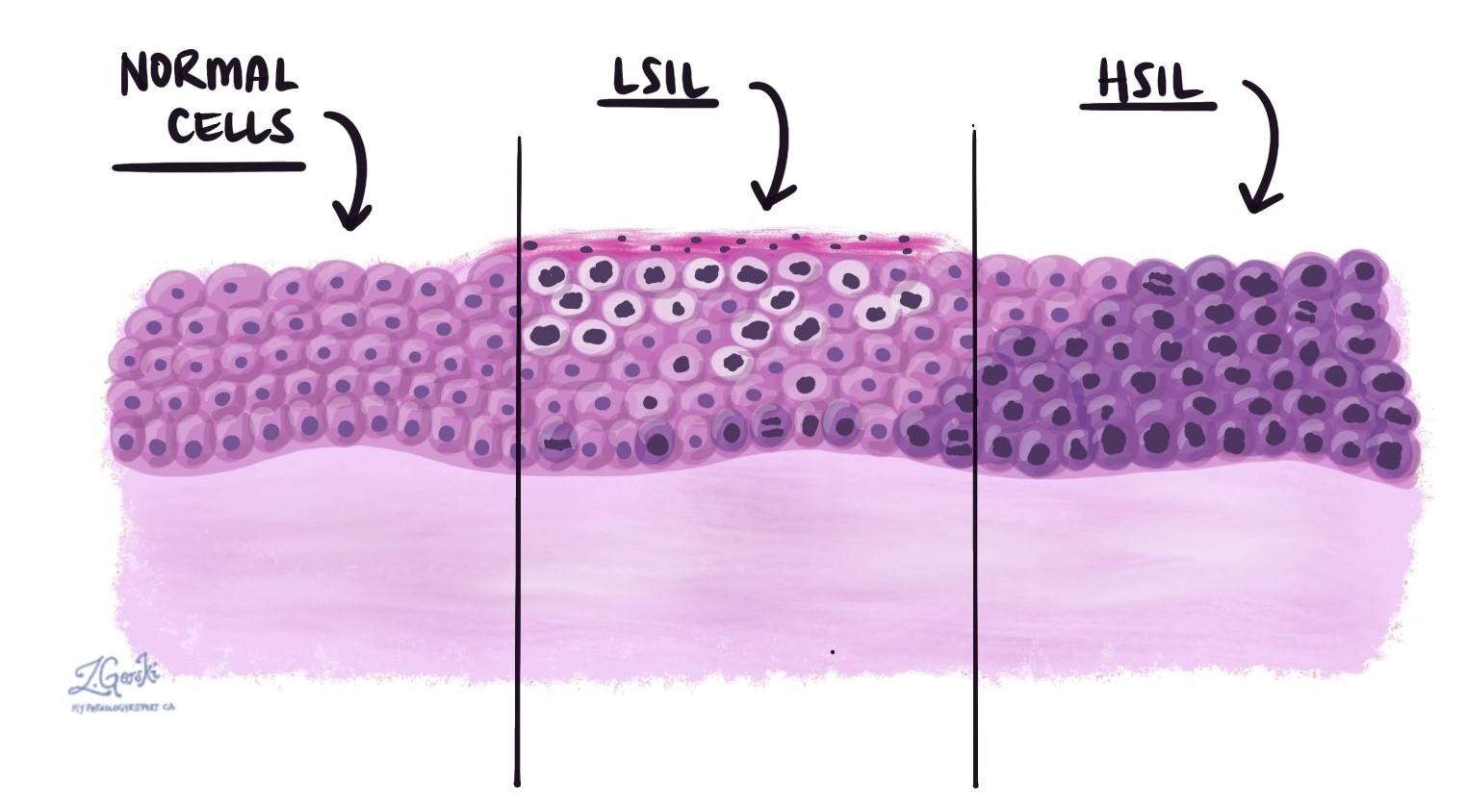 <p>Células con núcleos <strong>multicromáticos</strong> (hipercromáticos) y <strong>pleumórfico (muchas formas)</strong> con alteración en maduración epitelial</p>