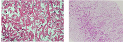 <p>What is this being used to diagnose, showing braching hyphae?</p>