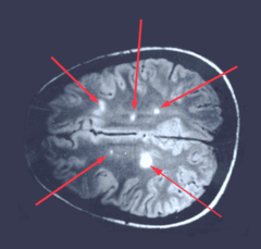 <p>Muscular Sclerosis</p><p>Dx: Oligoclonal IgG bands and periventricular plaques on MRI</p>