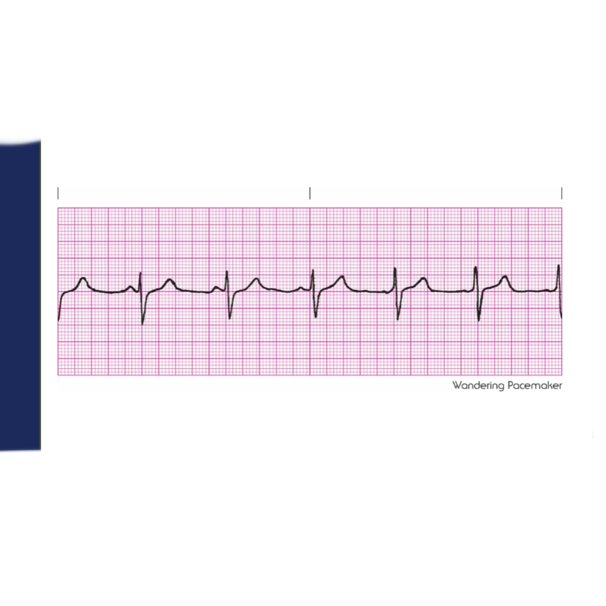 <p>Rules for Wandering Pacemaker includes </p>