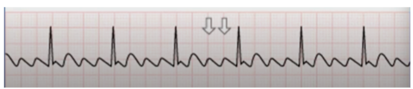 <ul><li><p><span style="background-color: transparent;">No P waves instead flutter waves (sawtooth pattern) are formed at rate of 250-350bpm</span></p></li><li><p><span style="background-color: transparent;">Only some impulses conduct through the AV node, usually every other impulse</span></p><ul><li><p><span style="background-color: transparent;">Heart rate: 75bpm</span></p></li><li><p><span style="background-color: transparent;">Rhythm: regular</span></p></li><li><p><span style="background-color: transparent;">P waves: flutter/sawtooth appearance</span></p></li><li><p><span style="background-color: transparent;">PR interval: none/unable</span></p></li><li><p><span style="background-color: transparent;">QRS complex: narrow 0.06 seconds</span></p></li></ul></li></ul><p></p>