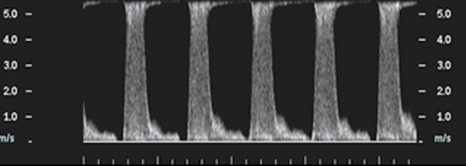 <p>Which combination of Doppler findings most strongly supports hemodynamically significant stenosis in this image?</p>