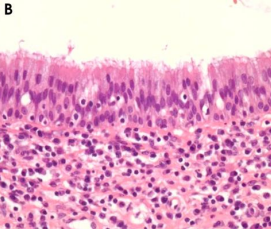 <p>A 42-year-old woman came complaining of intermittent stinging pain in her right cheek. There were no clinically abnormal findings in physical and oral examinations. Radiograph showed a cystic swelling in maxillary antrum. The patient only had a history of orthognathic surgery on both the maxilla and the mandible performed about 21 years prior to this visit</p>