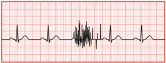 <p>Muscle movement on an EKG tracing</p>