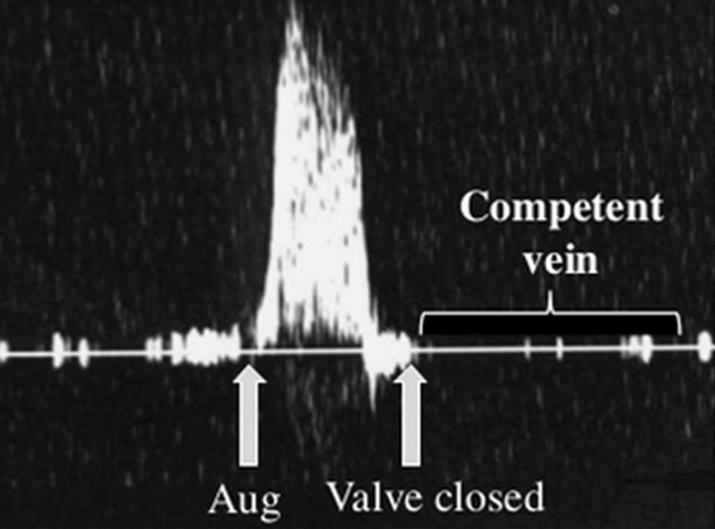 <p>augmentation with compression</p><p>no flow upon release of compression </p>