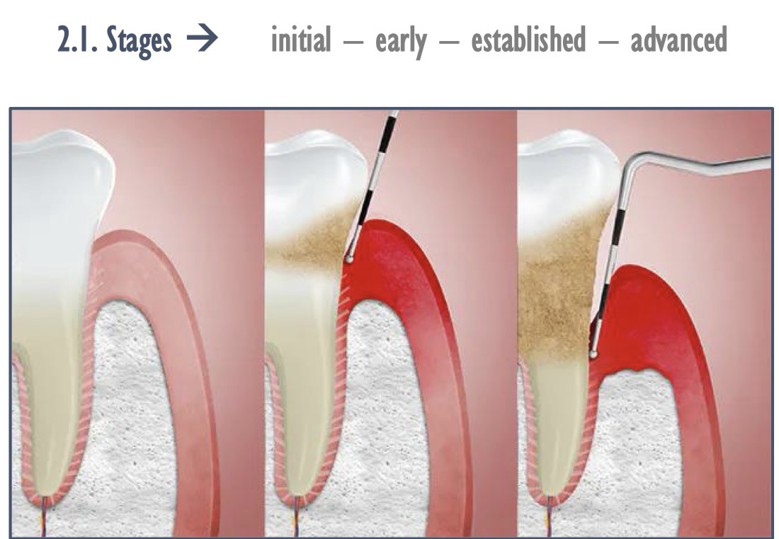 <p>The first manifestations of gingival inflammation are <strong>vascular changes</strong></p><p>Time passes, erythema signs may appear, especially capillary proliferation</p><p>Blood vessels dilate and congest, venous return is disturbed, slow blood circulation </p><p>Periodontal destruction</p>