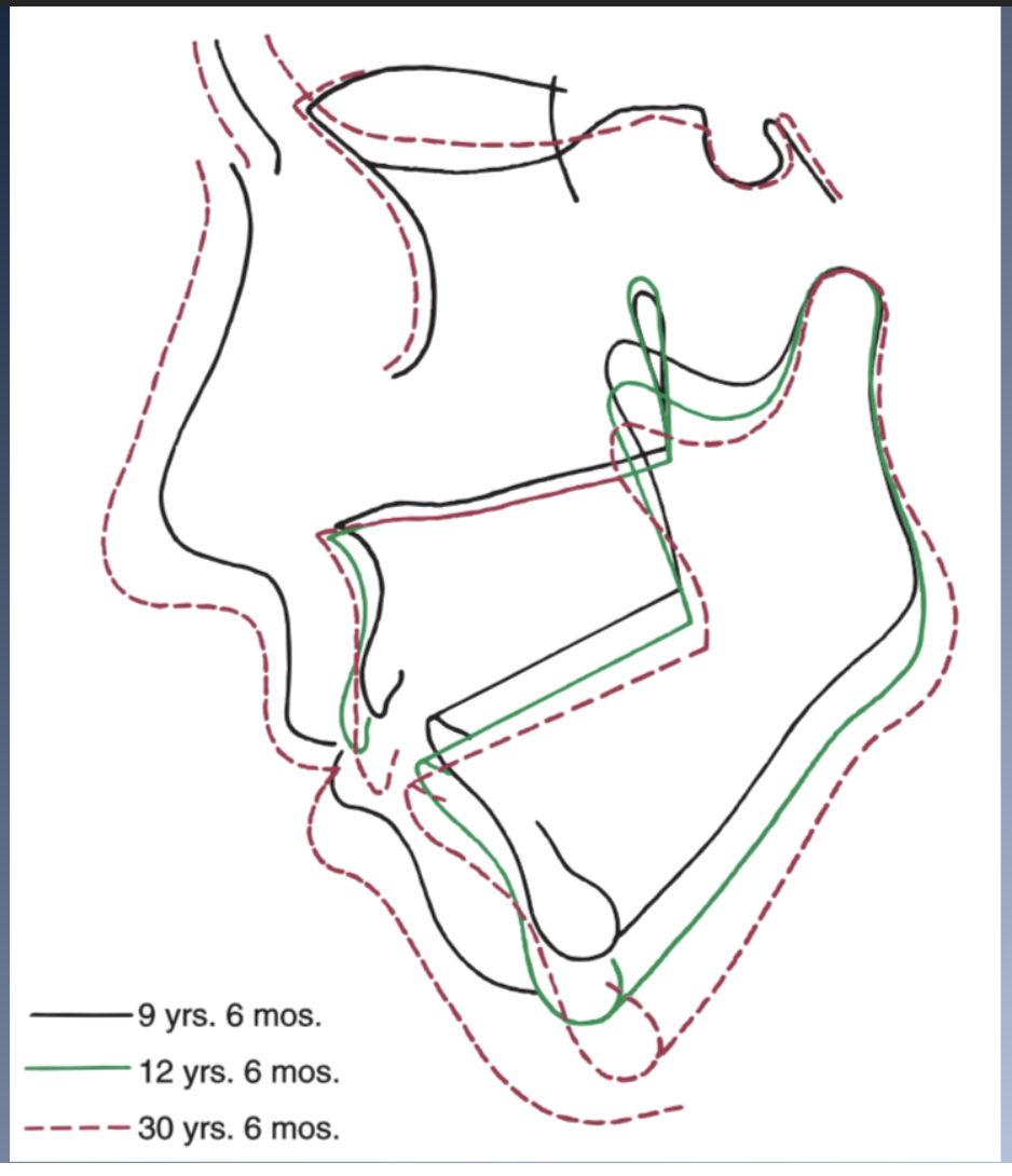 <p>Rotational patterns of growth are quite different for individuals with<br>short/long face types<br>LONG FACE<br>1. Palatal plane rotates down posteriorly → negative inclination.<br>2. Mandible shows an opposite, backward rotation.<br>1. Lack of the normal internal rotation (even backward internal<br>rotation)<br>2. Rotation is primarily centered around the condyle<br>3. á Mn plane angle<br>4. Associated with anterior open bite and Mn deficiency<br>5. Also occurs in patients with abnormalities or pathologic<br>changes affecting the TMJ.</p>