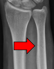<p>What fracture is this?</p>