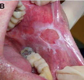 <p>type of papules that has <span style="color: red;">presence of squamous cells</span></p>