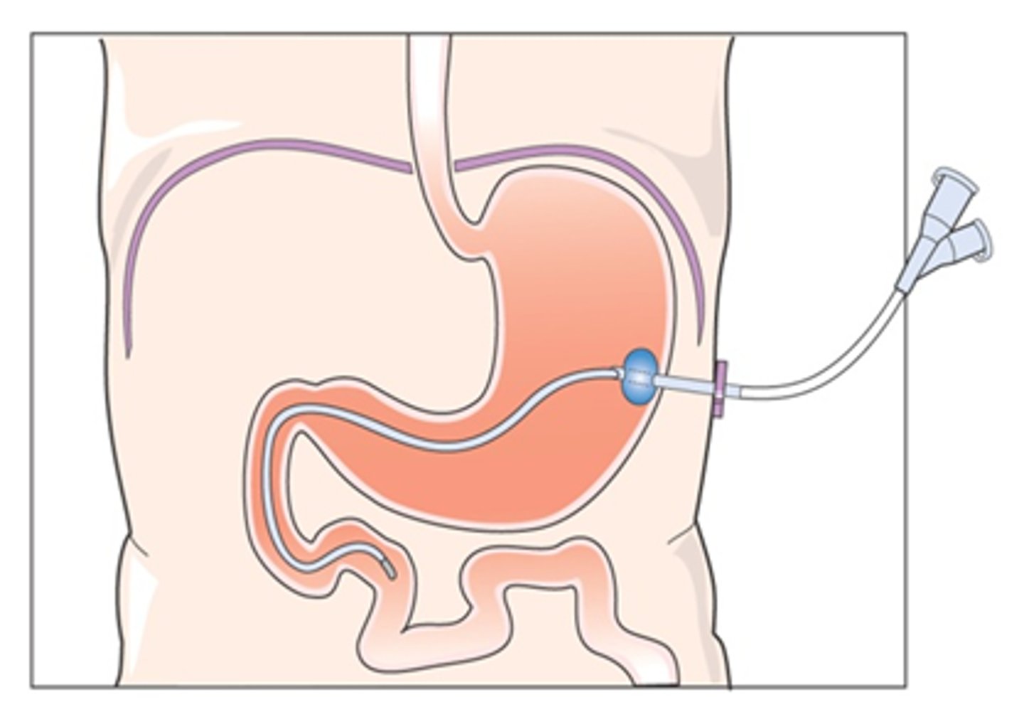 <p>feeding tube inserted through small surgical opening in abdomen</p>