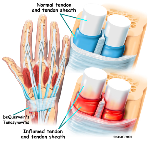 <p>Define this hand pathology</p>