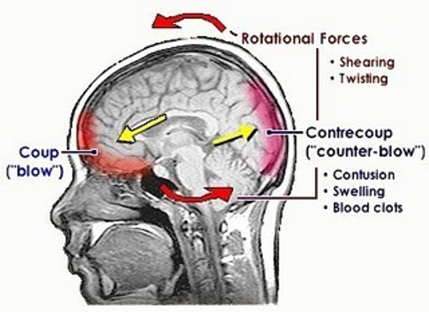 <p>This can occur as a result of a blow in which the brain ricochets off the opposite end of the cranium. Dizziness or a brief loss of consciousness may result.</p>