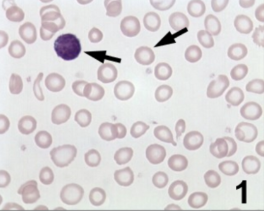 <ul><li><p><span style="background-color: transparent;">Retics = normal to low</span></p></li><li><p><span style="background-color: transparent;"><strong>Maturation Defect</strong>: Low HGB synthesis</span></p></li><li><p><span style="background-color: transparent;"><strong>Differential Diagnosis</strong>: Iron deficiency, thalassemia syndromes, Sideroblastic anemia (anemia of chronic disease)</span></p></li></ul><p></p>