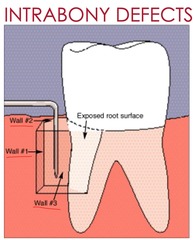 <p>Affects at least one tooth surface within alveolar bone, surrounded by 1, 2, or 3 bony walls or a combination.</p><p>(Explanation: Intrabony defects are localized, with varying bony walls determining the potential for regeneration (more walls = better regenerative potential).)</p>