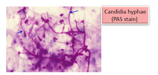 <ul><li><p>a cytologic smear</p></li><li><p>scraping surface cells form the skin or mucous membranes</p></li><li><p>non invasive procedure, no need for anesthesia</p></li><li><p>oral cytological smears, helpful in diagnosis of candidiasis</p></li><li><p><strong>brush biopsy, </strong>collecting cells for cytological evaluation</p></li><li><p>limited conclusions about the diagnosis </p></li></ul><p></p>