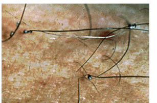 <p><strong>morpion</strong> - insecte</p><p></p><p>trapu, pattes développées</p><p></p><p>TTT: pyréthrine</p>