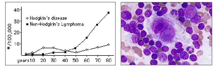 <p>- Thomas Hodgkin 1798-1866</p><p>.</p><p>Hodgkin lymphoma (Hodgkin's disease) is characterised by the Reed-Sternberg cell:</p><p>- Minor cell component with an inflammatory cell background</p><p>.</p><p>Bimodal age incidence:</p><p>- Young adults (20-30 yrs) and > 50 yrs</p>