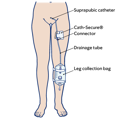 <p>What is a suprapubic catheter, and what 2 precautions must be taken during mobility?</p>
