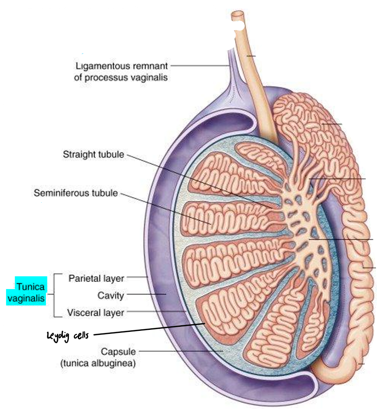 <p>A fluid-filled sac around the scrotum which contributes to scrotal swelling & hernias if not completely sealed off from the abdomen</p><ul><li><p>Forms if the ligamentous remnant of processus vaginalis is not completed sealed off once a child is born</p></li><li><p>Can lead to hernias or fluid from gut leaking into tunica vaginalis of testis</p></li></ul><p></p>