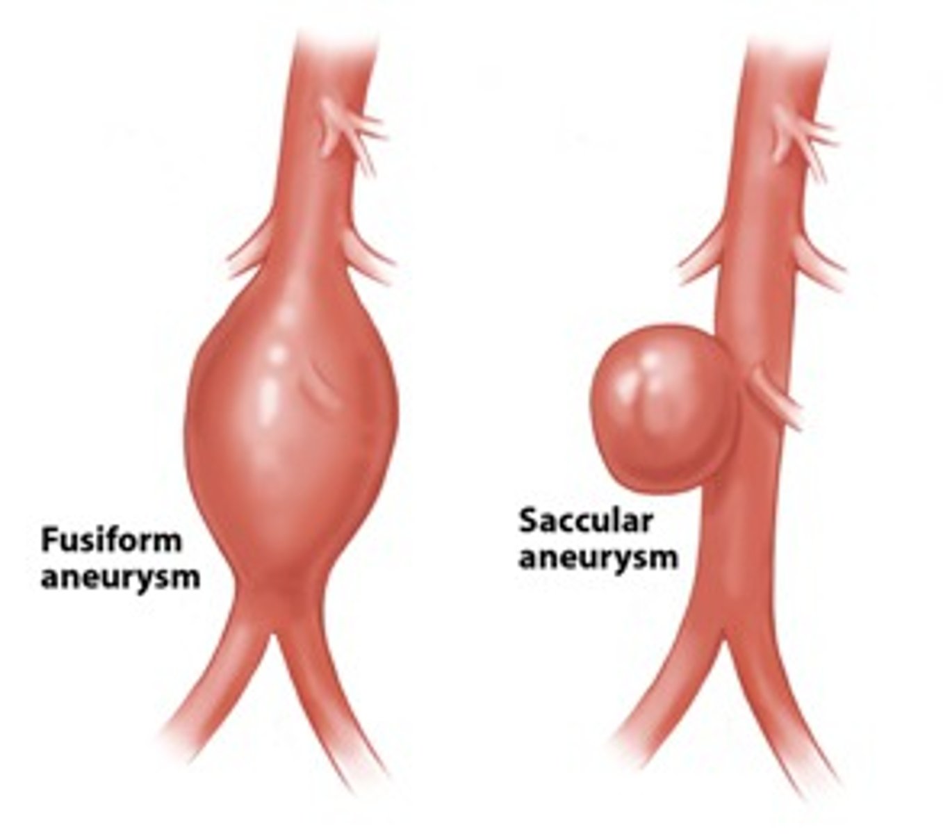 <p>can be born with or develop, serious with abdominal aorta/coronary arteries/brain</p>