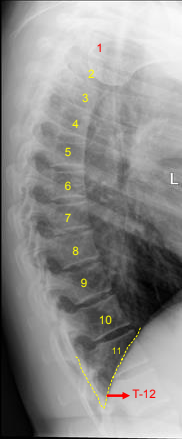 <ul><li><p>Thoracic vertebral bodies, intervertebral joint spaces, and intervertebral foramina</p></li><li><p>T1 to T3 will not be well demoed</p></li><li><p>Intervertebral disk spaces should be seen</p></li><li><p>Excessive rotation indicated by > 1/2” of space between separated posterior ribs</p></li></ul><p></p>