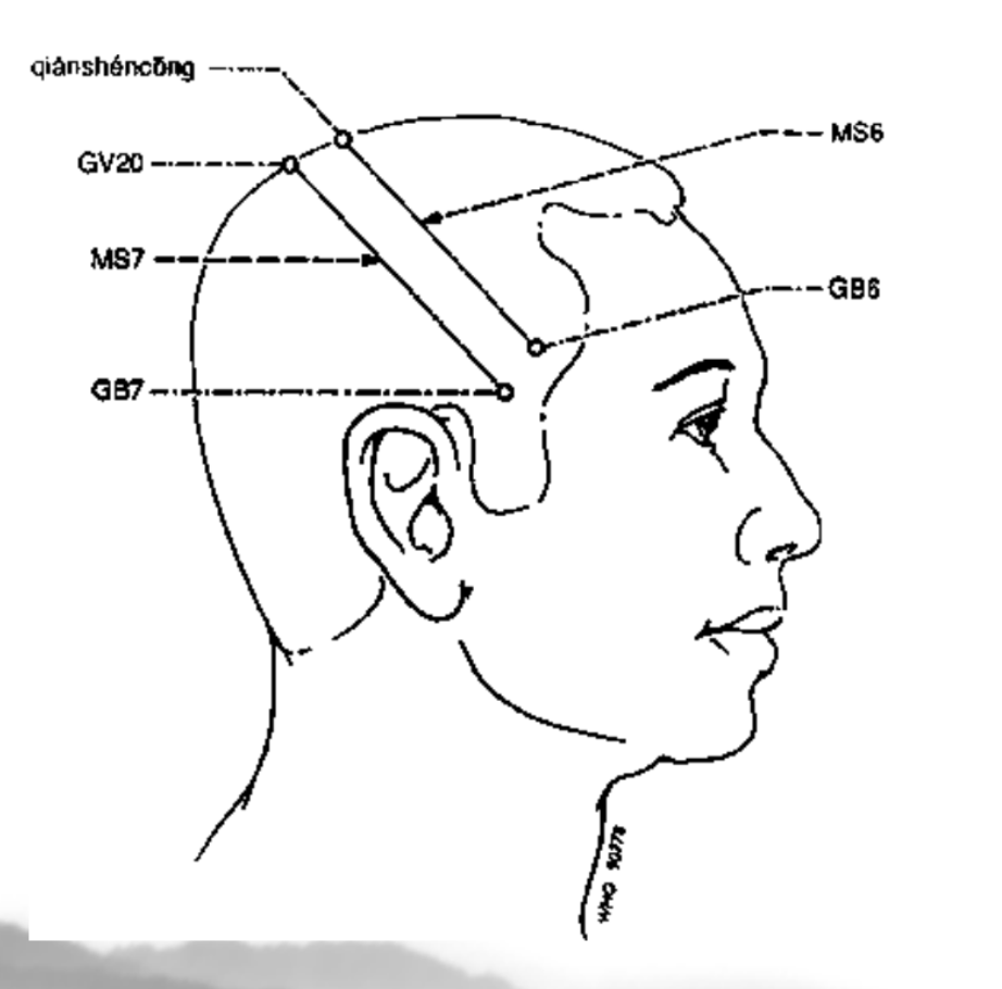 <p>From shishencong (1 cun anterior to DU 20) obliquely to GB 6</p><p><strong>-Mobility Impairment</strong></p><p>Upper 1/5: paralysis, dyscinesia (involuntary sporadic movements) in trunk &amp; lower limbs</p><p>middle 2/5: dyscinesia (involuntary erratic uncontrollable movements) in upper limbs</p><p>lower 2/5: discinesia in head &amp; face, aphemia (inability to produce speech), anaudia, salivation, central arteriosclerosis</p>