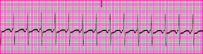 <p>Which rhythm is this?</p>