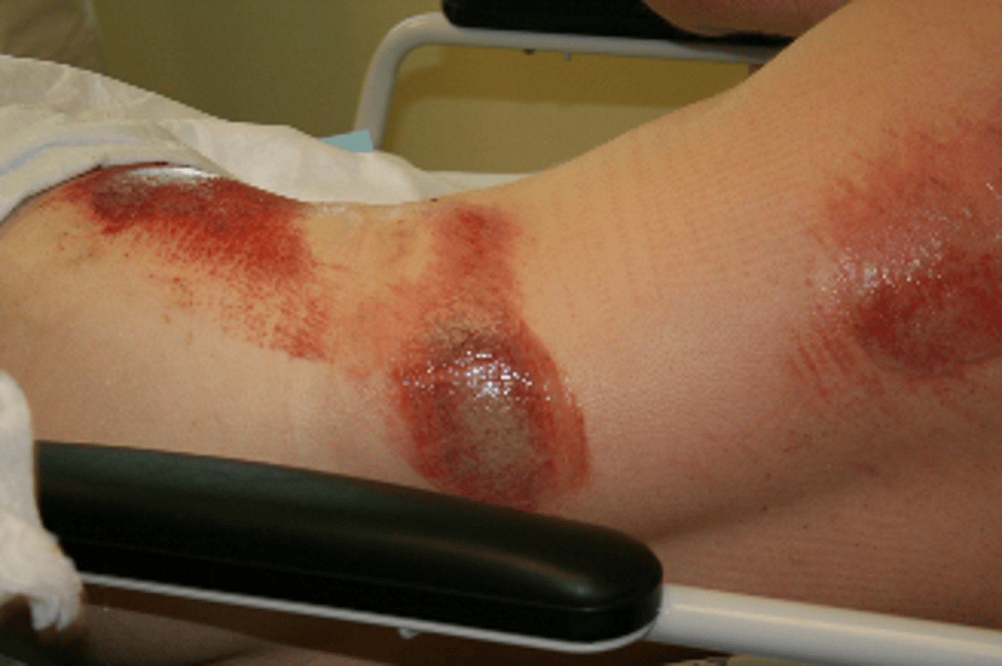 <p>involves the epidermis and the superficial dermis</p><p>blistering wounds that blanch with pressure</p><p>typically moist and weeping</p>