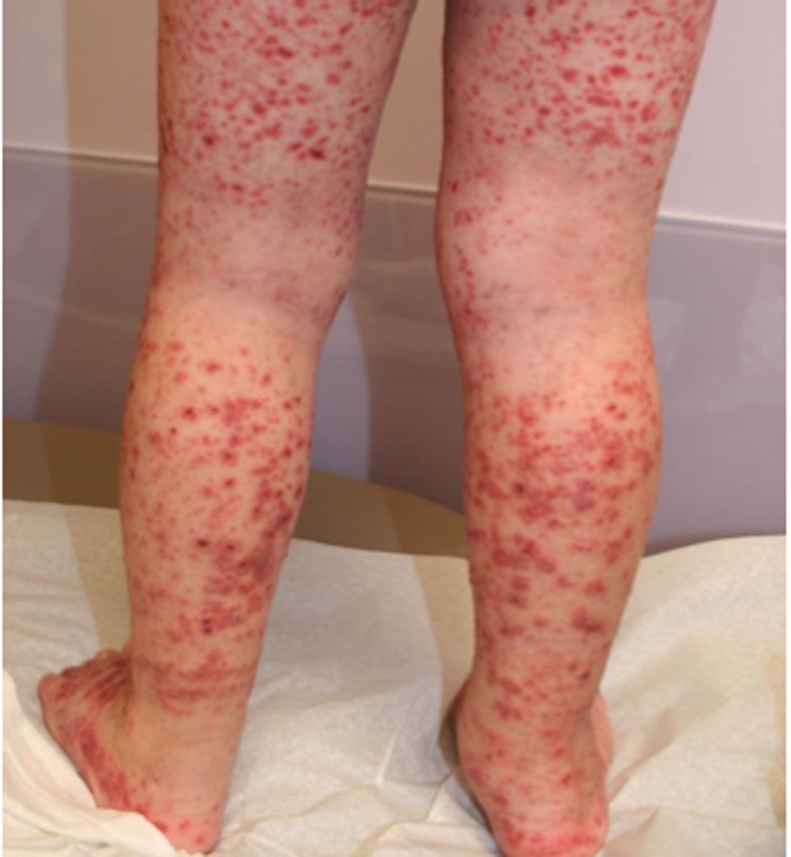 <p>multiple pinpoint hemorrhages and accumulation of blood under the skin</p>