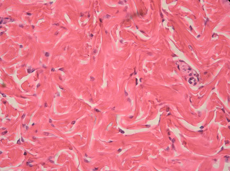 <p>Dense Irregular CT</p>