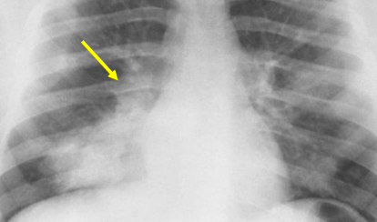 <p>Ill-defined consolidation at right base. Bacterial</p>
