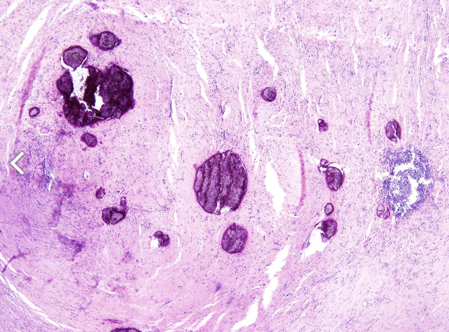 <p>Tumeur omentale chez un jeune adulte</p><p>Diagnostique</p><p>Age </p><p>localisation</p><p>Morphologie</p><p>IHC</p>