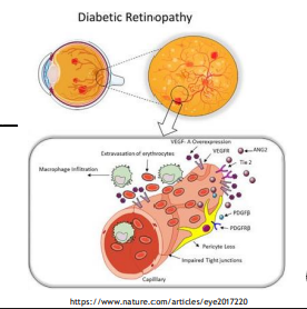 <ul><li><p>Damage to very small blood vessels</p></li><li><p>Seen in diabetic retinopathy</p><ul><li><p>Hyperglycemia degrades vessel walls</p></li><li><p>Inflammation + pericyte damage</p></li></ul></li></ul><p></p>
