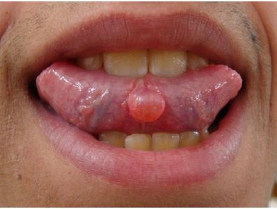 <p>cysts of blandin-nuhn</p>