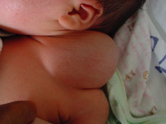 <p>A cystic hygroma is similar to increased NT or NF in that it is a build up of fluid at the back of the fetal neck. Cystic hygromas are more severe and contain cysts within the fluid. The majority of cystic hygromas eventually grow larger than the fetal head.</p>
